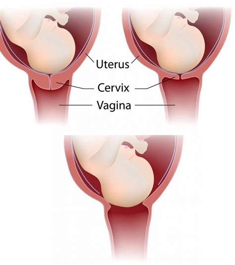 Cervix Changes During Birth Or Labor And Complications