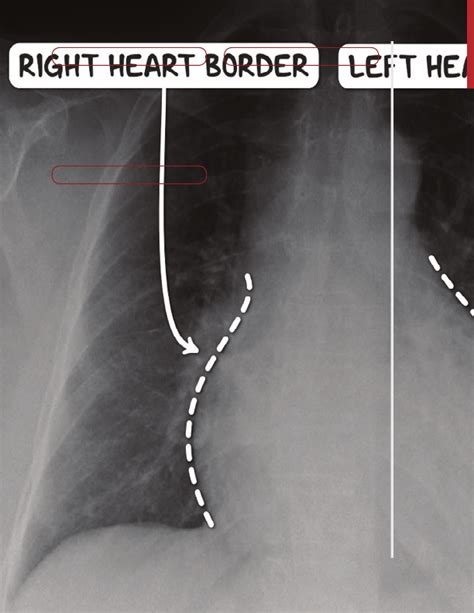 Cardiomyopathy Notes Diagrams And Illustrations Osmosis