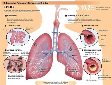 Enfermedad Pulmonar Obstructiva Crónica EPOC Alergia en República Dominicana Dr Guillermo