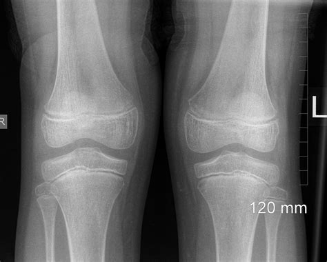 Normal Pediatric Knee X Ray