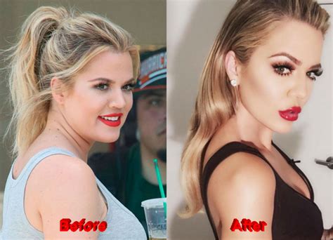 khloe kardashian plastic surgery photos before after