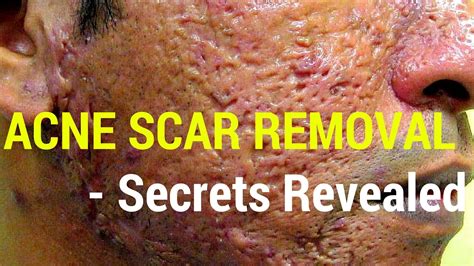 How To Treat Acne Scars Dermatology Secrets Revealed Youtube