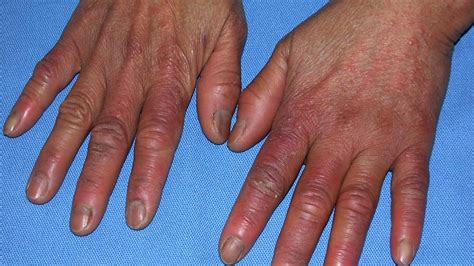 Chilblains On Fingers Toes And Feet Causes Pictures Treatment