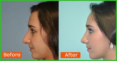 Exercise After Rhinoplasty What You Need To Know Justinboey