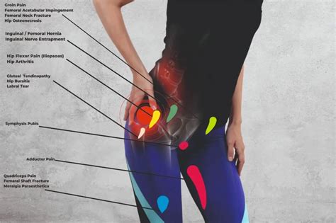 Hip Pain Location Diagram Anterior Posterior Lateral View