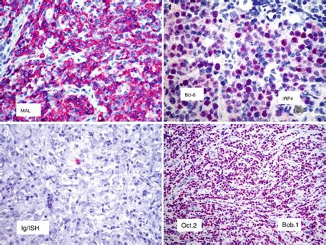 Primary Mediastinal Large B Cell Lymphoma Oncohema Key