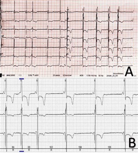 Panel A Electrocardiogram Short Pr Interval With Slight Septal