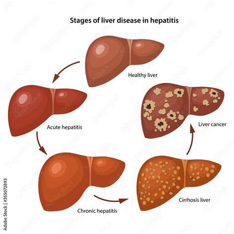 Stages Of Liver Disease In Hepatitis With Description Corresponding