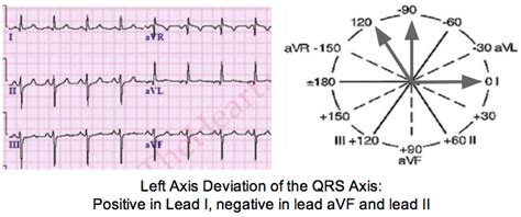 It has several possible implications. Determine Axis on a 12-lead ECG Tracing | LearntheHeart.com