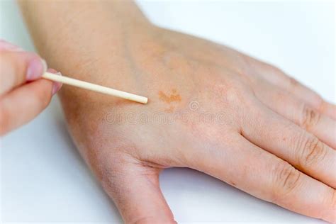 A Birthmark Or A Mole On A Woman Skin Stock Photo Image Of Female