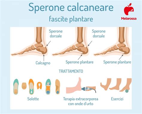 Fascite Plantare Che Cos Sintomi Cause Diagnosi E Cure