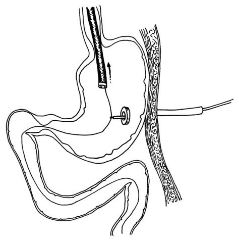 Percutaneous Endoscopic Gastrostomyjejunostomy Pegpej Tube
