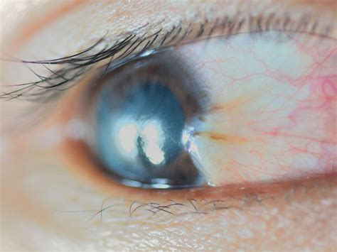 Causes Of A Bubble Blister Or Bump On Your Eyeball
