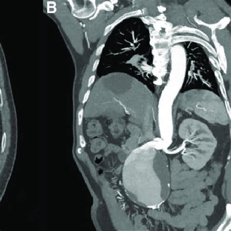 Preoperative Computed Tomography Angiography Revealed The Infrarenal