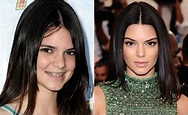 El antes y el después de las cirugías de Kendall Jenner