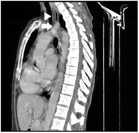 Contrast Neck And Chest Ct Scan Sagittal View Showing A Foreign Body