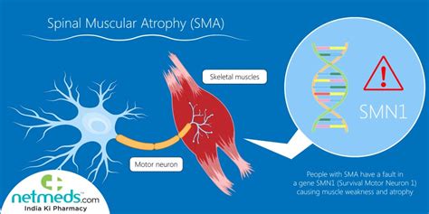 Spinal Muscular Atrophy Causes Symptoms Of This Genetic Disorder With
