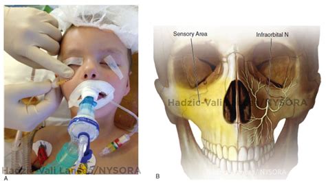 Nerve Blocks Of The Face Nysora The New York School Of Regional