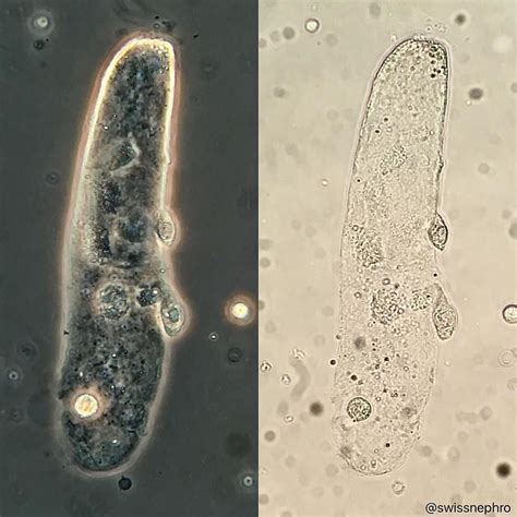 Hyaline Waxy Cast With Cellular Elements Two Cells Are Protruding From