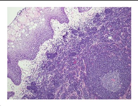 Figure 1 From A Rare Cause Of Tonsil Mass In A Child Lymphoid Polyp