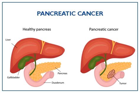 Pancreatic Cancer Symptoms Causes Risks And Diagnosis