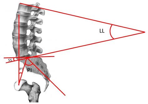 Figure 1 From Evaluation Of Sagittal Balance And Spinopelvic Parameters