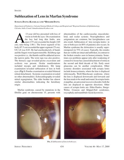 Pdf Subluxation Of Lens In Marfan Syndrome