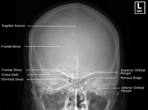 Skull Radiographic Anatomy Radiology Medical