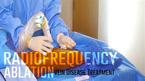 Radiofrequency Ablation Vein Disease Treatment Chronic Venous