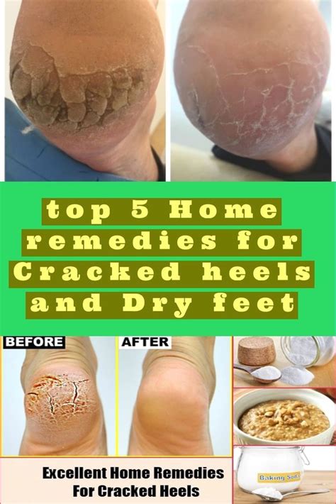 Pin By Kalitkinamiloslava On Skin Care Dry Foot Dry Cracked Feet