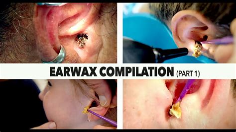 Massive Earwax Removal Compilation Part 1 Dr Paul Youtube