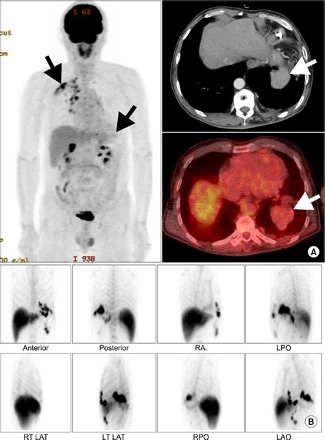 A Positron Emission Tomography Computed Tomography Pet Ct Multiple