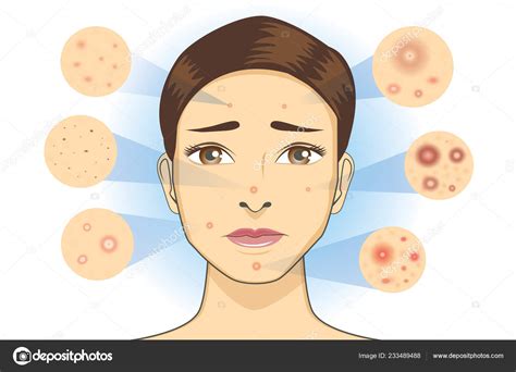 All Type Acne Icon Facial Skin Woman Illustration Dermatology Diagram