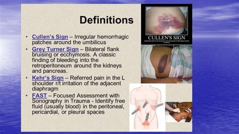 Acute Abdomen Intestinal Obstruction Peritonitispptx