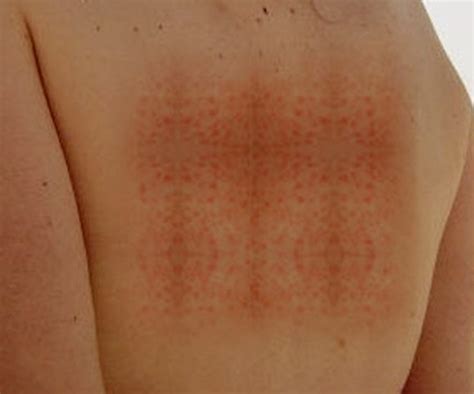 German Measles Pictures Symptoms Causes Treatment