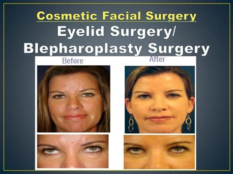 Ppt Eyelid Surgery Dr Gregory Casey Powerpoint Presentation Free