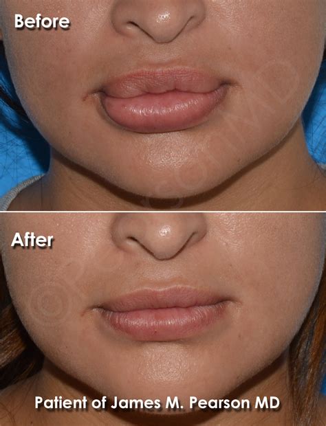 Can You Get Plastic Surgery On Your Lips Lipstutorial Org