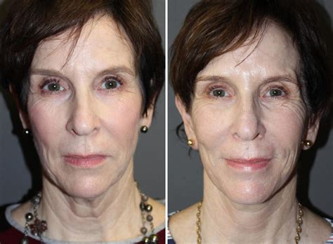 Patient 177928556 Facelift Before And After Photos Boston Center For