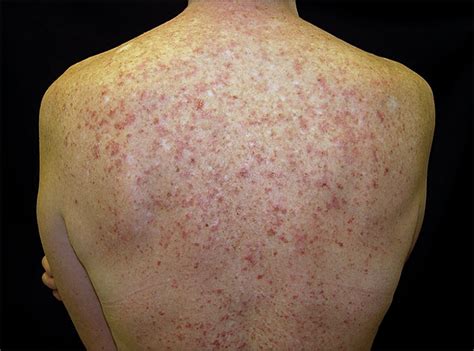 Subacute Cutaneous Lupus Erythematosus Exacerbated Or Induced By