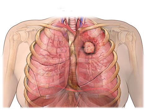 lung carcinoid tumors facts city of hope california