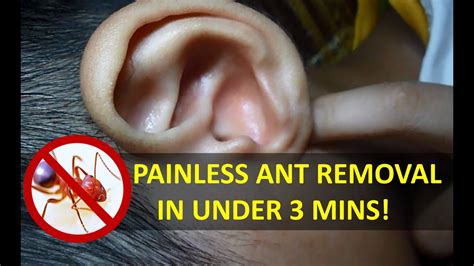 nasty ant removed from ear quick and easy youtube