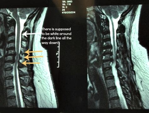 It is important to know what is the actual cause to your neck pain because that will impact your. Cervical Fusion (Neck) Surgery next month