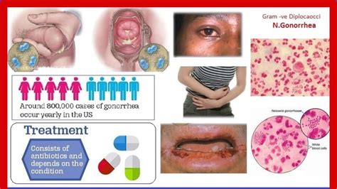 Gonorrhea Causes Signs And Symptoms Diagnosis And Treatment Youtube