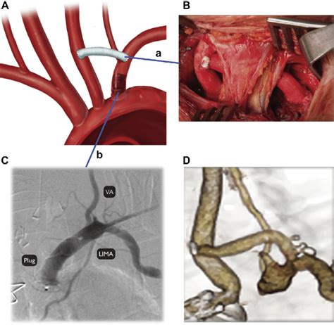 A And B In Elective Cases A Left Carotid To Subclavian Artery Bypass