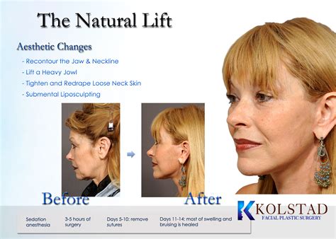Lifestyle Lift Facelift Procedure Some States Have More Than One
