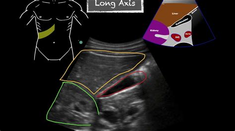 Pocus Gallbladder Ultrasound Anatomy Youtube