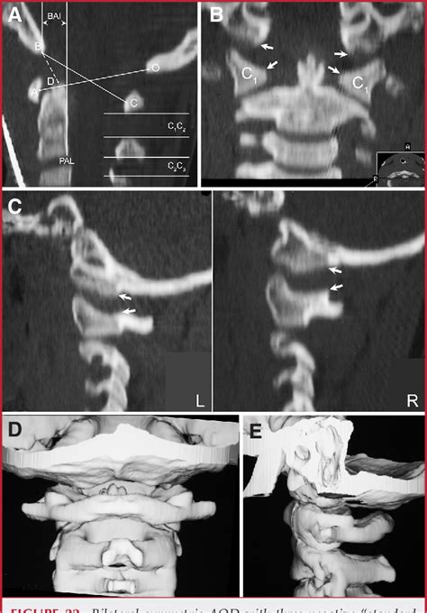 Figure 1 From Atlanto‐occipital Dislocation—part 2 The Clinical Use Of