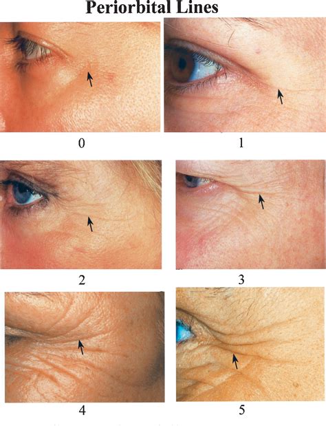[pdf] a classification of facial wrinkles semantic scholar