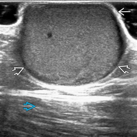 Subcutaneous Dermoid Cyst Ultrasound