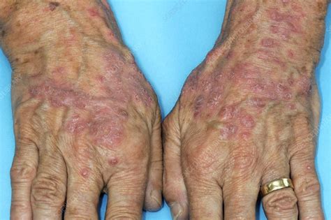 Psoriasis On The Hands Stock Image C0103332 Science Photo Library